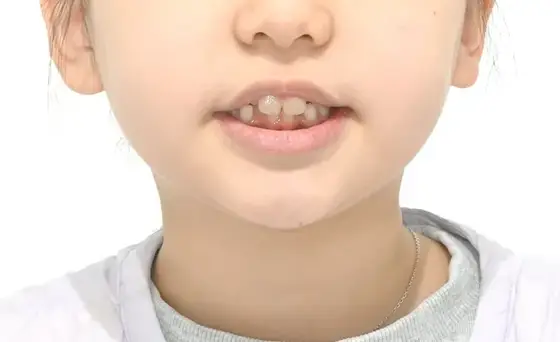 공간 부족 · 악궁 확장 사례 03(악궁 확장) 치료 전 얼굴 정면 사진