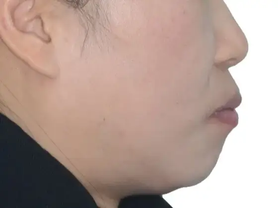 강동구 둔촌동 연세꿈꾸는치과 돌출입 교정 사례 01(발치 교정) 치료 전 얼굴 옆모습 사진