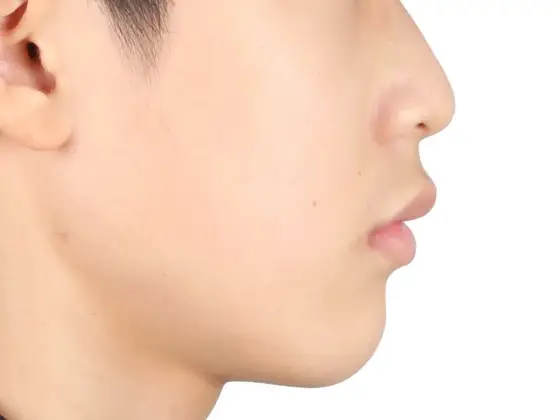 돌출입 교정 사례 03(발치 교정) 치료 후 얼굴 옆모습 사진 – 앞니 각도를 세워 입매를 정리