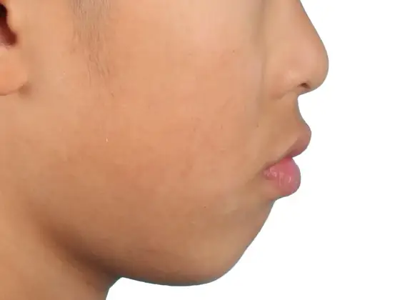 돌출입 교정 사례 03(발치 교정) 치료 전 얼굴 옆모습 사진
