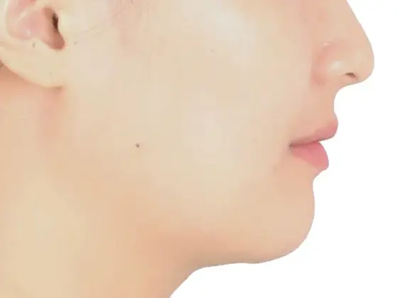 무턱 교정 사례 02(비수술 교정) 치료 후 얼굴 옆모습 사진 – 무턱과 돌출입 동시 개선, 치료기간 25개월