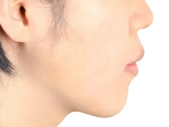 주걱턱 (비수술) 사례 02(비수술 교정) 치료 후 얼굴 옆모습 사진 – 교합 관계 재설정, 치료기간 18개월