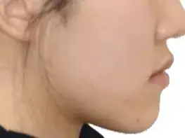 주걱턱 (비수술) 사례 03(비수술 교정) 치료 후 얼굴 옆모습 사진 – 경도 주걱턱 단기 개선, 치료기간 18개월