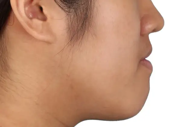 주걱턱 (수술) 사례 01(수술 교정) 치료 전 얼굴 옆모습 사진